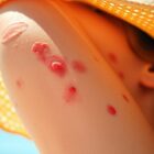 Przegrzanie skóry latem: jak rozpoznać objawy i bezpiecznie zapobiegać uszkodzeniom skóry