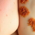 Klimatyzacja a trądzik: jak dbać o skórę, by uniknąć przesuszenia i nawrotów wyprysków